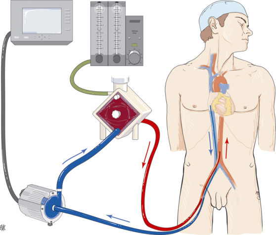 ECMO